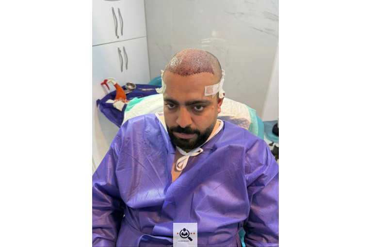 کاشت مو مریم عباسی در شیراز