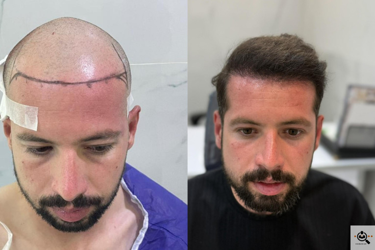 کاشت مو مریم عباسی در شیراز