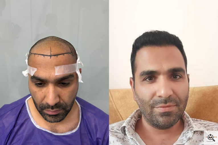 کاشت مو مریم عباسی در شیراز