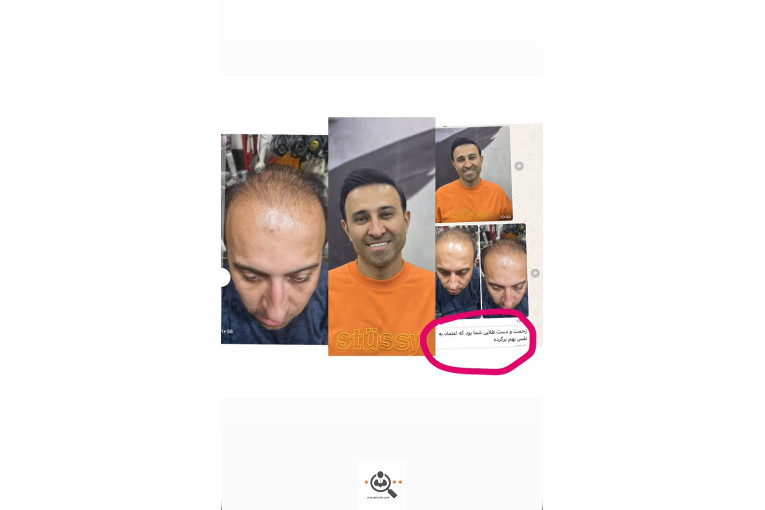 کاشت مو مریم عباسی در شیراز