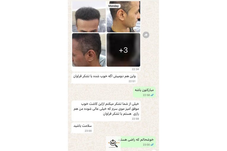 کاشت مو مریم عباسی در شیراز