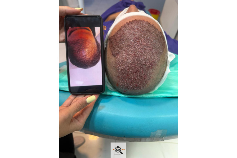 کاشت مو مریم عباسی در شیراز