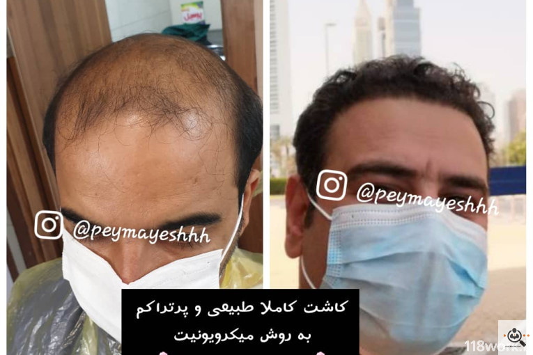 خدمات کاشت و ترمیم مو پیمایش در شیراز