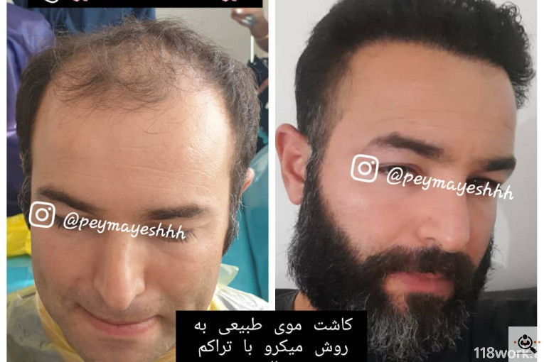 خدمات کاشت و ترمیم مو پیمایش در شیراز