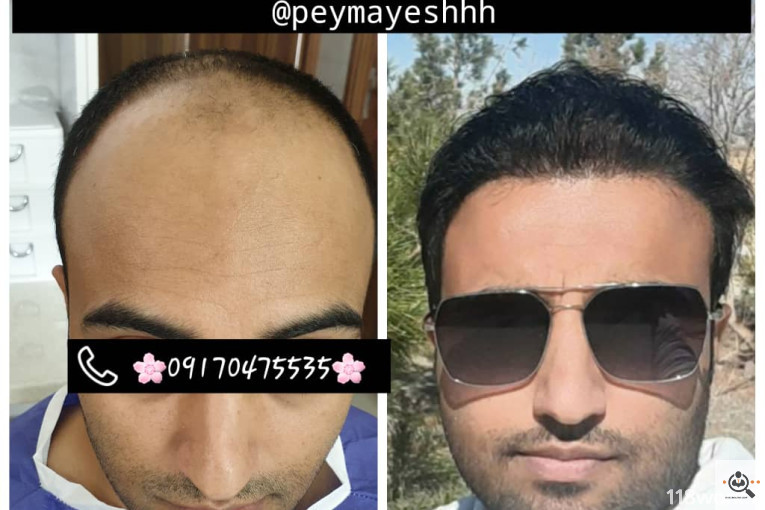 خدمات کاشت و ترمیم مو پیمایش در شیراز