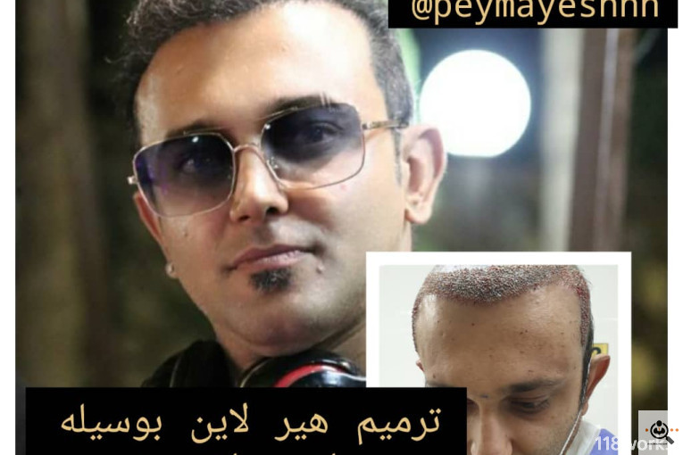 خدمات کاشت و ترمیم مو پیمایش در شیراز