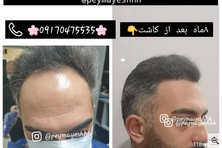 خدمات کاشت و ترمیم مو پیمایش در شیراز