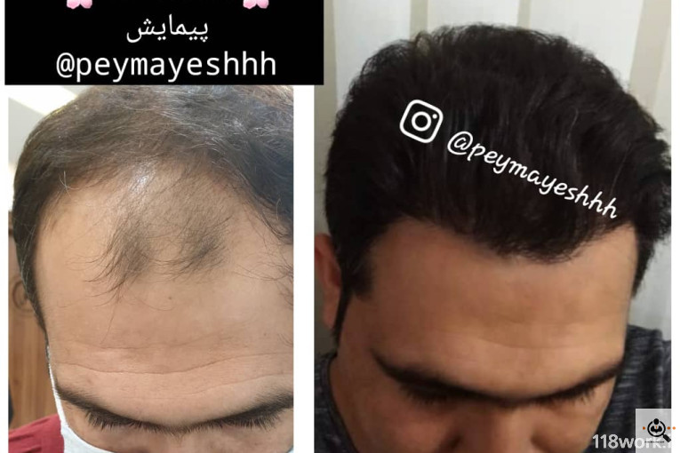 خدمات کاشت و ترمیم مو پیمایش در شیراز