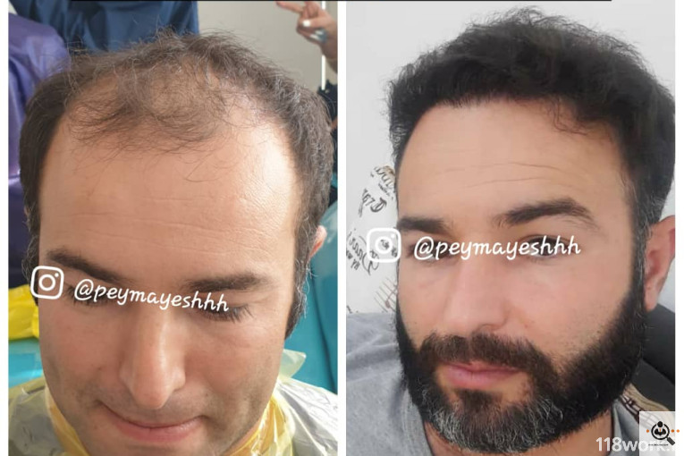 خدمات کاشت و ترمیم مو پیمایش در شیراز