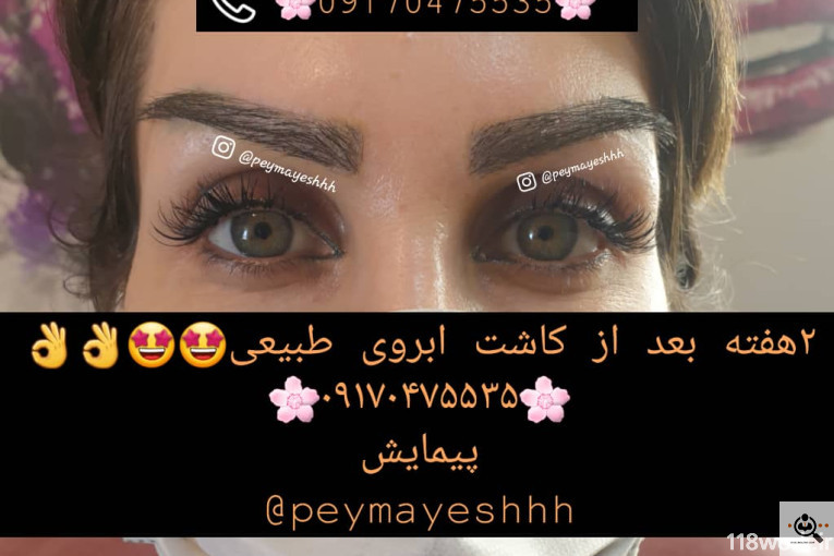 خدمات کاشت و ترمیم مو پیمایش در شیراز