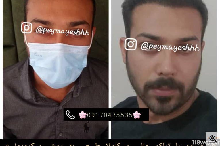 خدمات کاشت و ترمیم مو پیمایش در شیراز