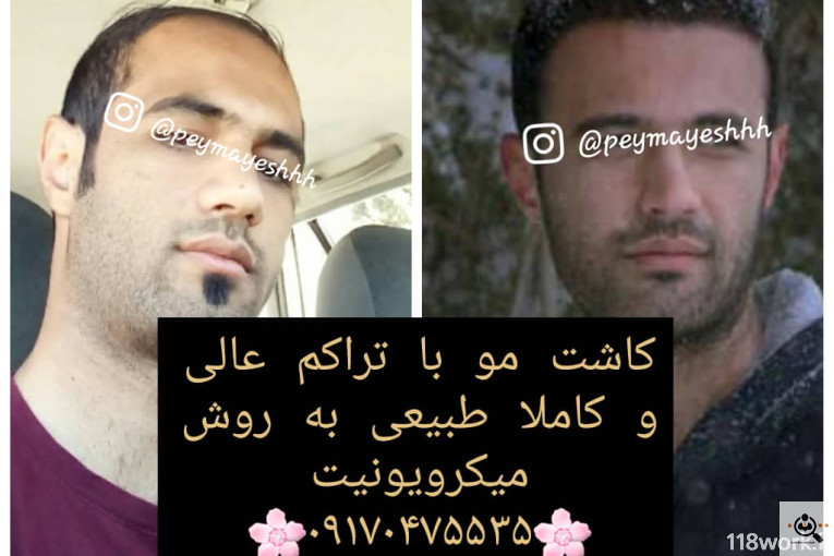 خدمات کاشت و ترمیم مو پیمایش در شیراز