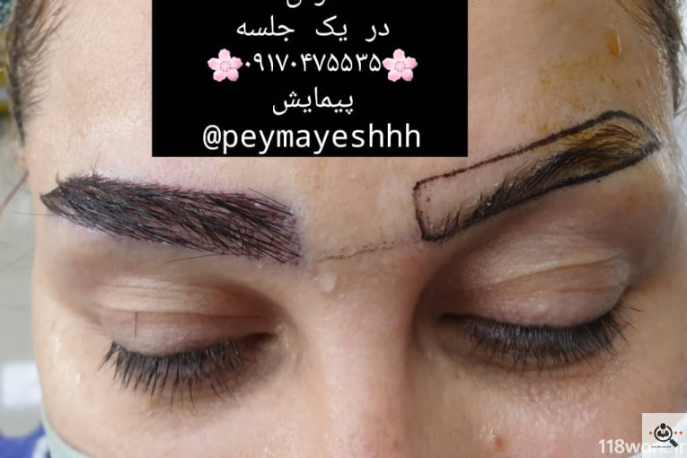 خدمات کاشت و ترمیم مو پیمایش در شیراز