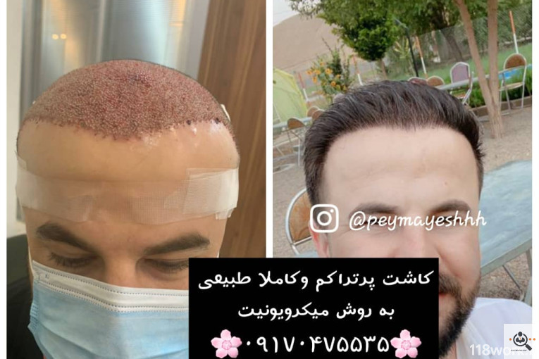 خدمات کاشت و ترمیم مو پیمایش در شیراز