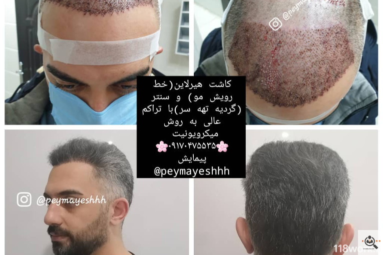 خدمات کاشت و ترمیم مو پیمایش در شیراز