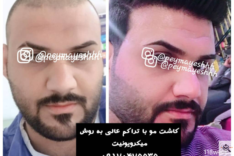 خدمات کاشت و ترمیم مو پیمایش در شیراز