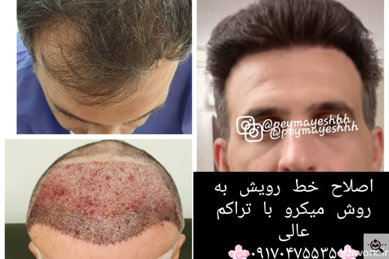 خدمات کاشت و ترمیم مو پیمایش در شیراز