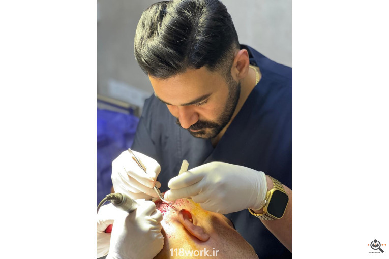 خدمات تخصصی کاشت مو و ابرو شفائی در رشت