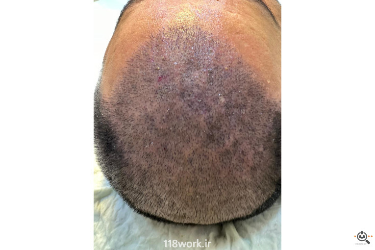 خدمات تخصصی کاشت مو و ابرو شفائی در رشت