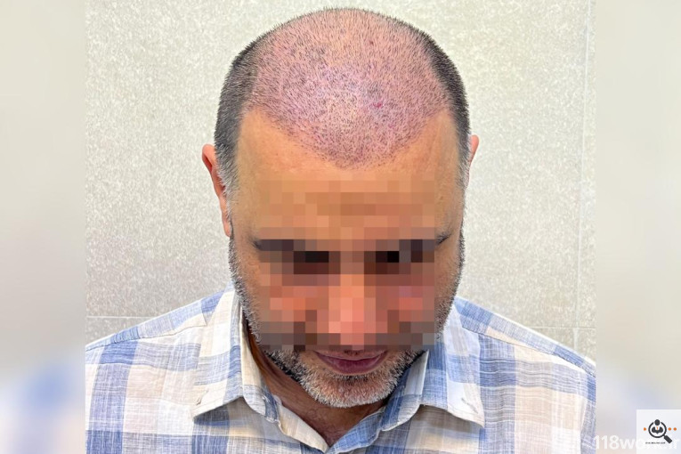 خدمات تخصصی کاشت مو و ابرو شفائی در رشت