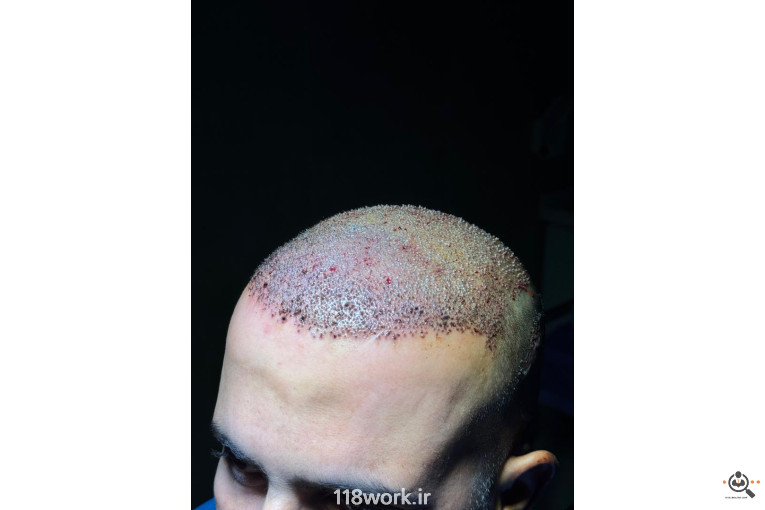 خدمات تخصصی کاشت مو و ابرو شفائی در رشت