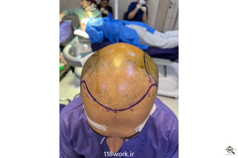 خدمات تخصصی کاشت مو و ابرو شفائی در رشت