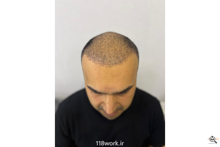 خدمات تخصصی کاشت مو و ابرو شفائی در رشت