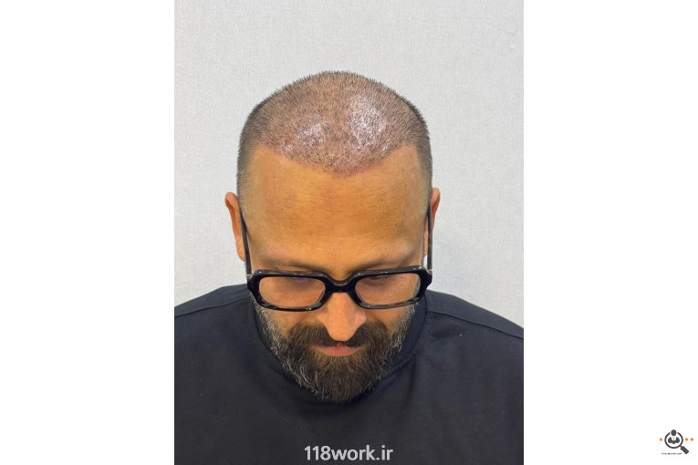 خدمات تخصصی کاشت مو و ابرو شفائی در رشت