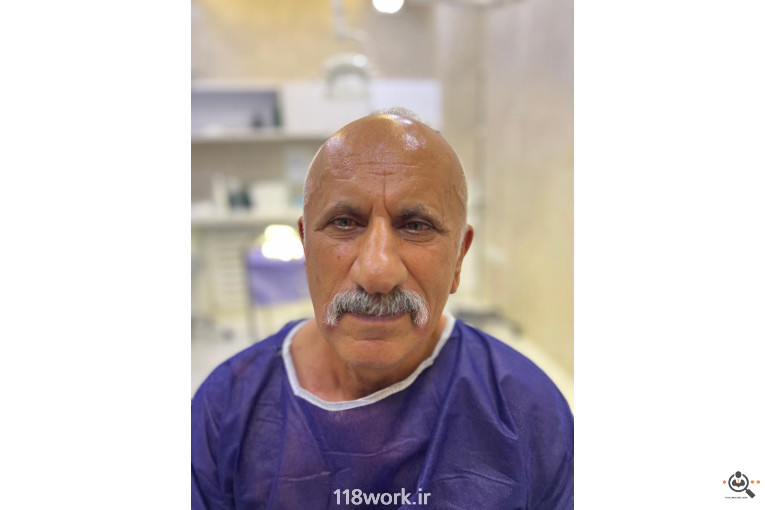 خدمات تخصصی کاشت مو و ابرو شفائی در رشت