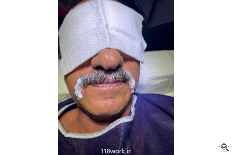 خدمات تخصصی کاشت مو و ابرو شفائی در رشت