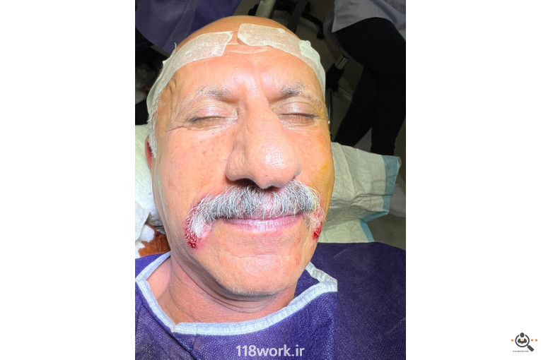 خدمات تخصصی کاشت مو و ابرو شفائی در رشت