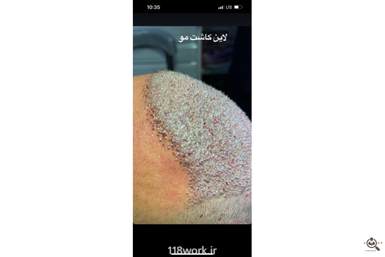 خدمات تخصصی کاشت مو و ابرو شفائی در رشت