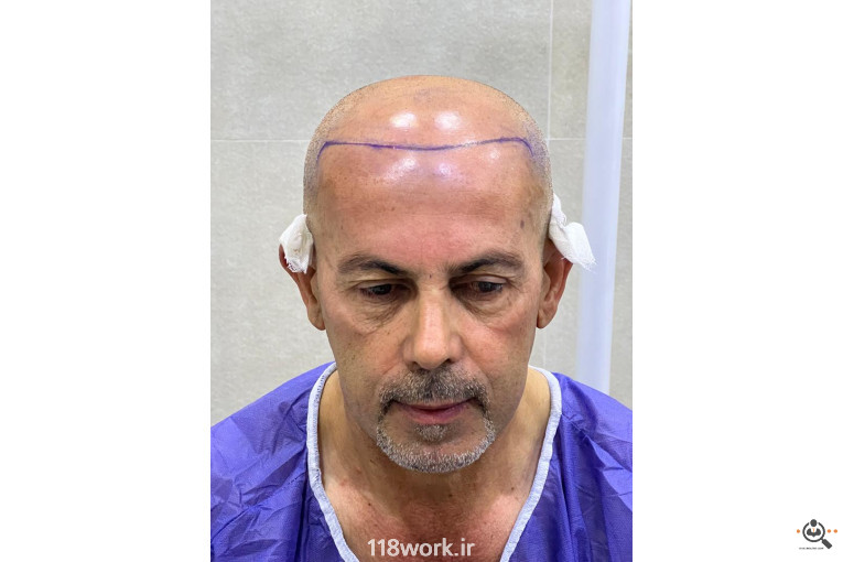 خدمات تخصصی کاشت مو و ابرو شفائی در رشت