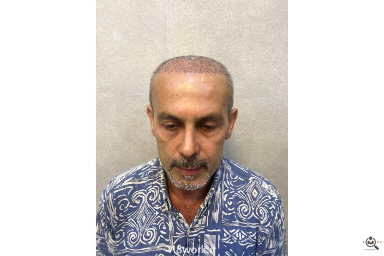 خدمات تخصصی کاشت مو و ابرو شفائی در رشت