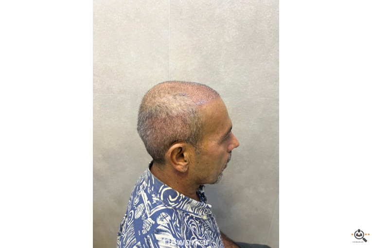 خدمات تخصصی کاشت مو و ابرو شفائی در رشت