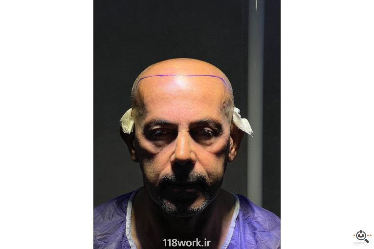 خدمات تخصصی کاشت مو و ابرو شفائی در رشت