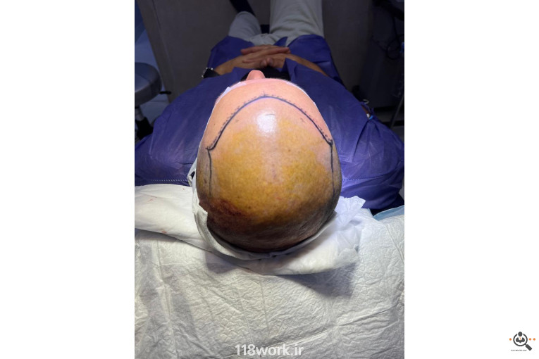 خدمات تخصصی کاشت مو و ابرو شفائی در رشت