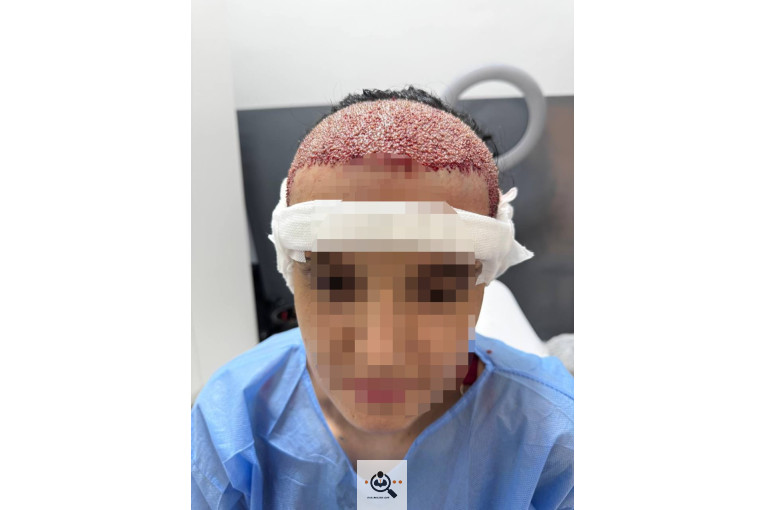 خدمات تخصصی کاشت مو و ابرو شفائی در رشت