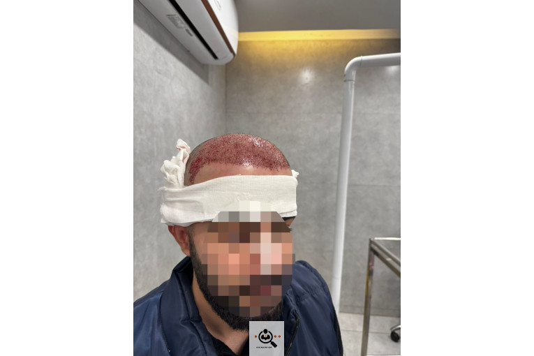 خدمات تخصصی کاشت مو و ابرو شفائی در رشت