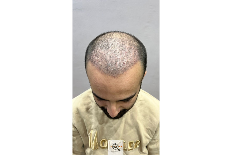 خدمات تخصصی کاشت مو و ابرو شفائی در رشت