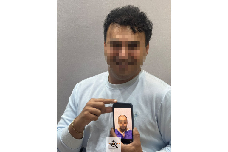 بهترین و پرتراکم ترین کاشت مو و ابرو در رشت