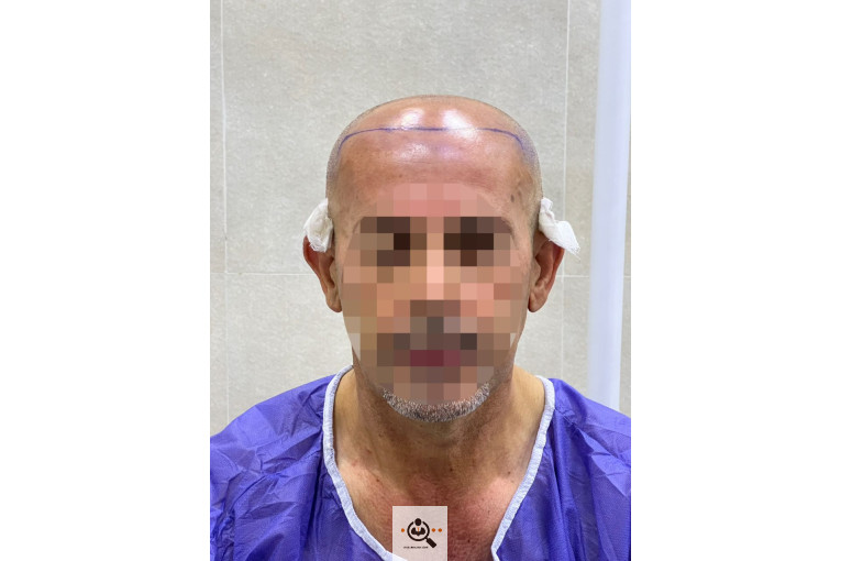 بهترین و پرتراکم ترین کاشت مو و ابرو در رشت