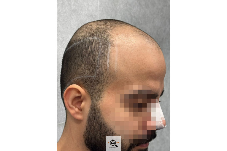 بهترین و پرتراکم ترین کاشت مو و ابرو در رشت