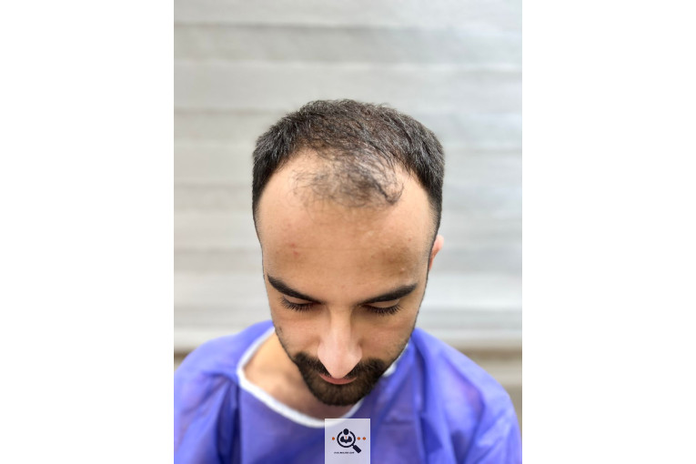 بهترین و پرتراکم ترین کاشت مو و ابرو در رشت