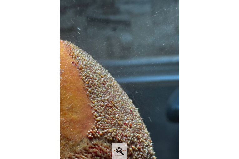 بهترین و پرتراکم ترین کاشت مو و ابرو در رشت