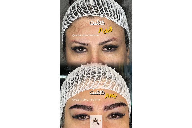 بهترین کاشت ابرو و میکروکاشت در شیراز