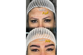 بهترین کاشت ابرو و میکروکاشت در شیراز