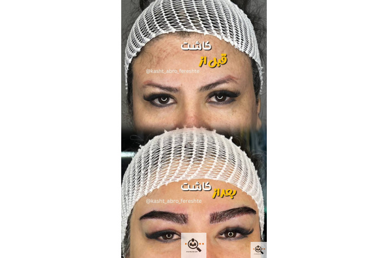 بهترین میکروکاشت در شیراز