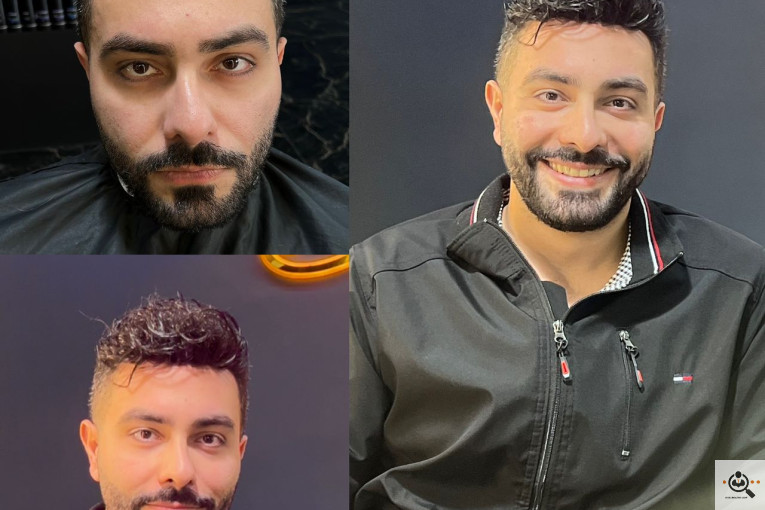 پروتز مو در سراسر ایران