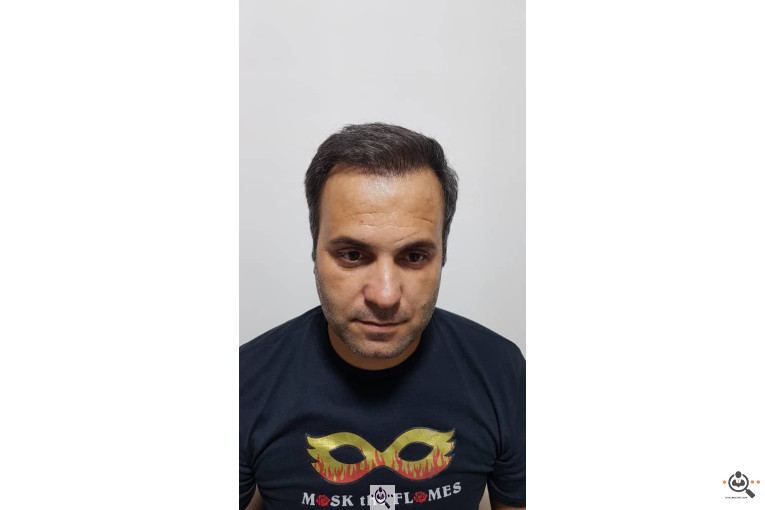کاشت مو فرشته غلامی در تهران و ایلام09123267841